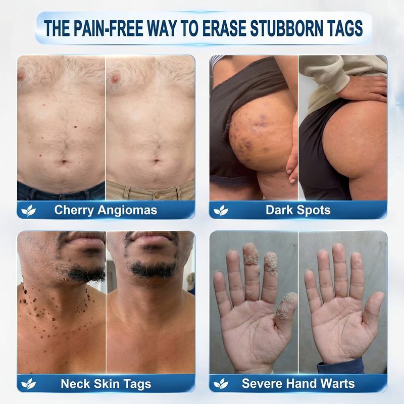 Raznave®7-Day Skin Tag & Spot Eraser, Painless Scar-Free Imperfection Removal Rollerball Pen