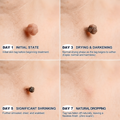 Raznave®7-Day Skin Tag & Spot Eraser, Painless Scar-Free Imperfection Removal Rollerball Pen